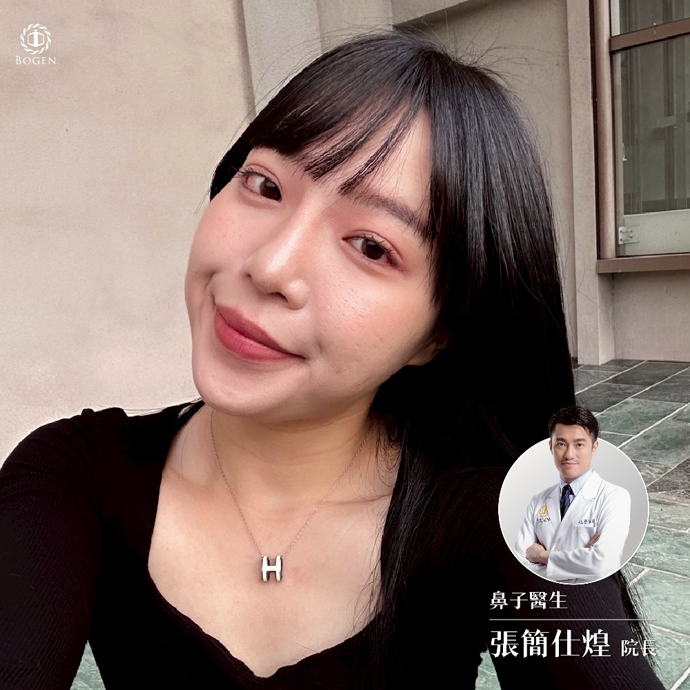 鼻重修,自體肋軟骨鼻重修,博恩妍